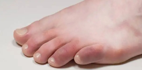 bruised toe