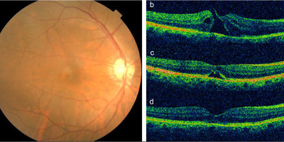 macular hole