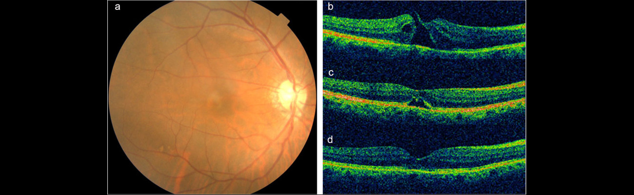 macular hole