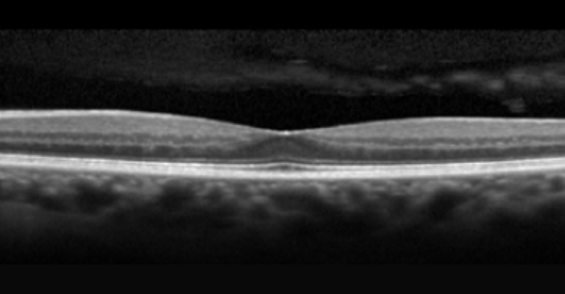 healthy macula